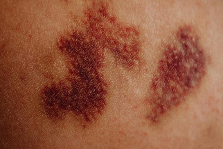 Avoiding Shingles: Your Comprehensive Guide to Prevention and Protection