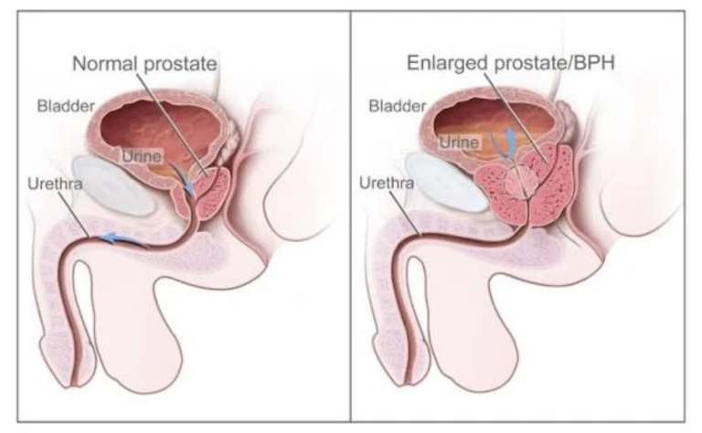 Prostate Disease Prevention and Treatment